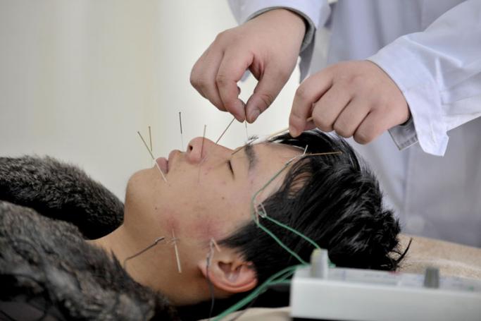 A patient receives acupuncture treatment at a traditional Chinese medicine hospital in Shenyang, northeast China. Photo: Mark/EPA
