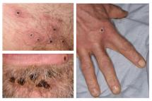 A handout picture made available by the UK Health Security Agency (UKHSA) on June 22, 2022 shows a collage of monkeypox rash lesions at an undisclosed date and location. Photo: AFP