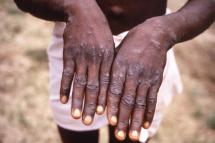 This handout photo provided by the Centers for Disease Control and Prevention was taken in 1997 during an investigation into an outbreak of monkeypox, which took place in the Democratic Republic of the Congo (DRC), and depicts the dorsal surfaces of a monkeypox case in a patient who was displaying the appearance of the characteristic rash during its recuperative stage. Photo: AFP